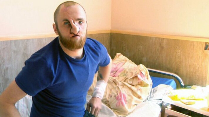 «І дихати можу, і запахи відчуваю»:  хірурги відновлюють обличчя воїну